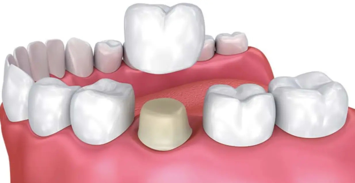 Couronne Dentaire Tunisie